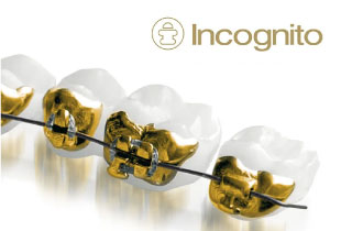 Брекеты Incognito